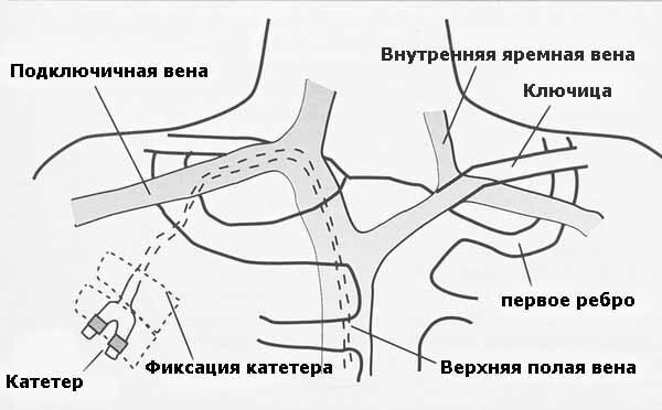 Катетер в вену - постановка. Как поставить катетер в вену