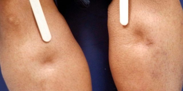 Отеки при сердечной недостаточности: симптомы, патогенез, лечение