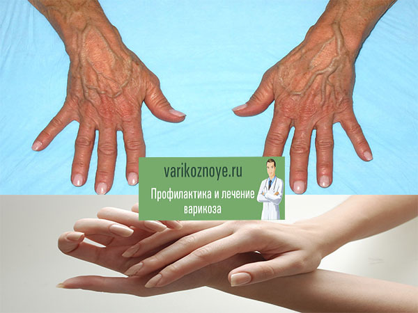Варикоз на руках: симптомы, может, может ли быть, варикозное расширение вен, лечение, причины, верхних конечностей