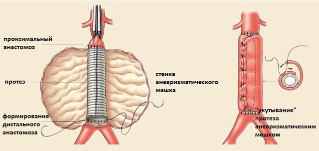 Аневризма грудного отдела аорты: диагностика и лечение
