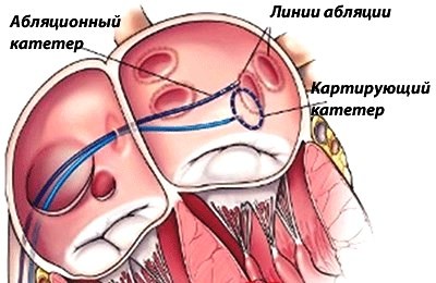 Мерцательная аритмия сердца - причины и симптомы, лечение консервативное и оперативное