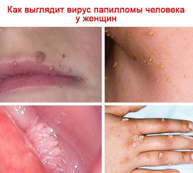 Вирус папилломы человека у женщин симптомы фото