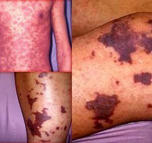 Тромбоцитопения: причины и лечение у взрослых