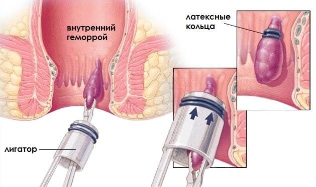 Что такое лигирование внутреннего геморроидального узла — Сайт о геморрое