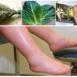 Отеки при варикозе - снимаем быстро и надолго