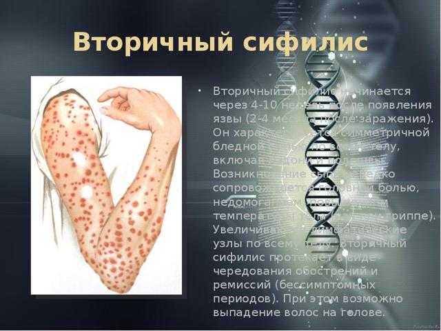 Сифилис у женщин – первые признаки, симптомы, лечение