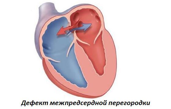 Неполная блокада левой ножки пучка Гиса - причины, лечение
