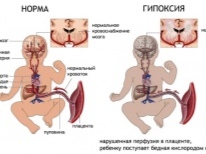 Могут ли желудочки головного мозга уменьшится сами. Расширение боковых желудочков головного мозга