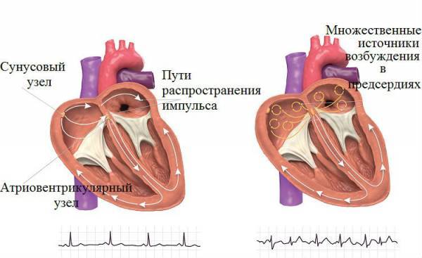 Трепетание предсердий на ЭКГ, причины трепетания желудочков