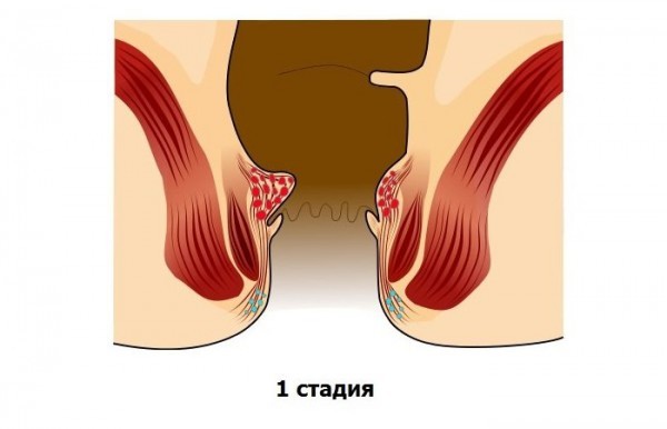 Первая стадия геморроя: лечение, причины, симптомы