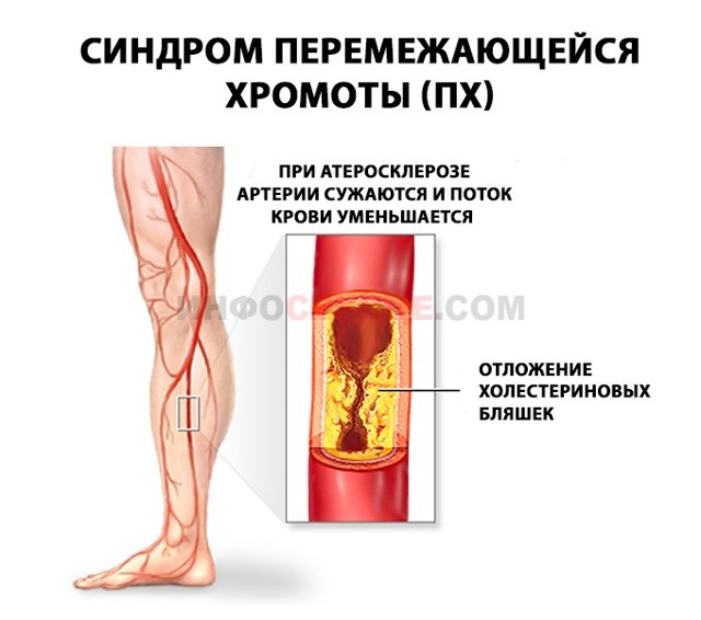 Перемежающаяся хромота - что это такое? - Лечение ног
