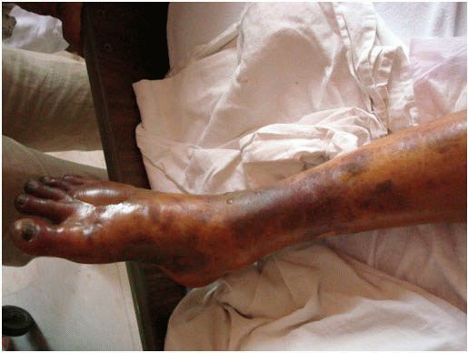 Мазь от гангрены - Все про гипертонию