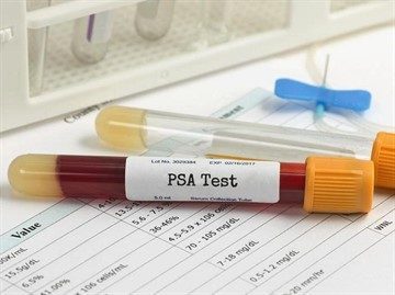 Анализ ПСА - норма у мужчин расшифровка общий и свободный процентное соотношение по возрасту и крови, что показывает таблица