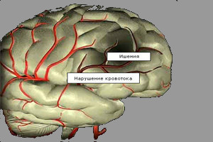 Хроническая ишемия головного мозга 2 ст декомпенсация - Все про гипертонию