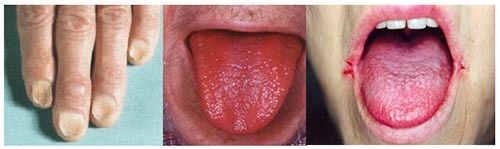 Железодефицитная анемия симптомы