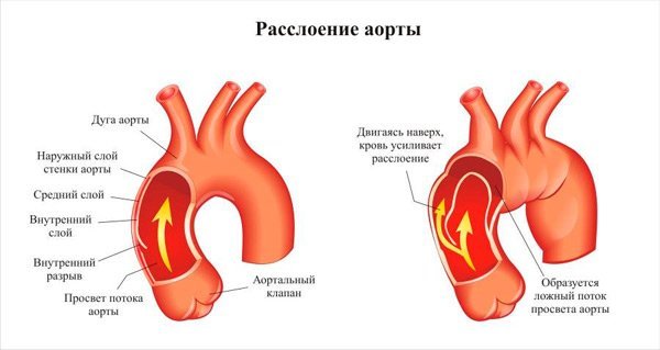 Аневризма аорты восходящего отдела, расширение аорты - лечение. Протезирование аорты в СПб