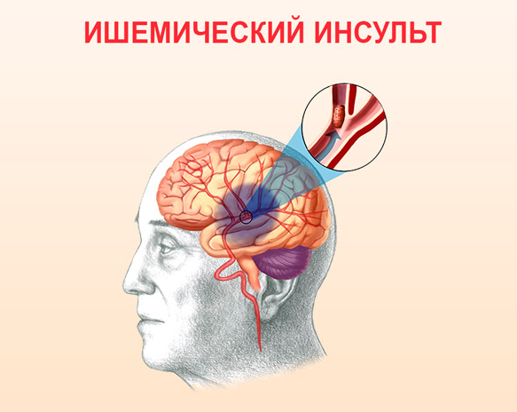 Ухудшение состояния после инсульта через год - Инсульт