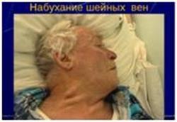 Трикуспидальная регургитация — степени и лечение