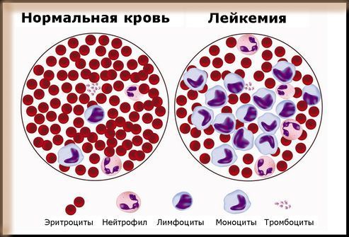 Что такое Эритремия?