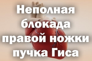 Неполная блокада правой ножки пучка Гиса