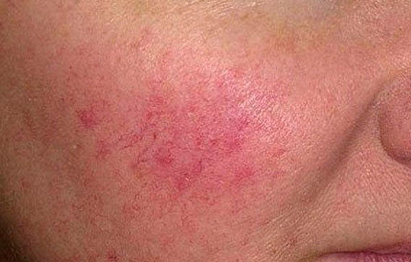 Как убрать красные сосуды на лице в домашних условиях