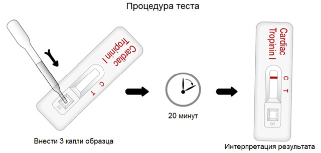 Тропонин в крови: что это, виды (T, I, C), нормы, повышение в анализах, уровень при инфаркте. 3 правила подготовки к проведению тропонинового теста