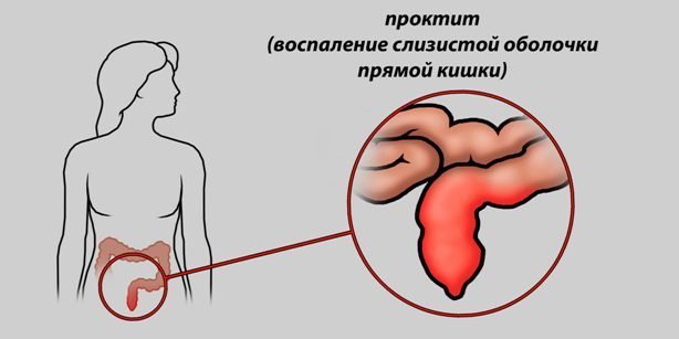 Кровь из заднего прохода при испражнении - причины и лечение