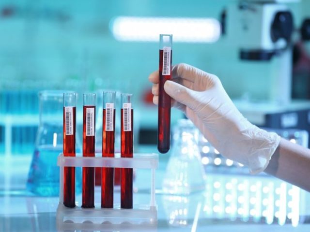 АСЛО в крови: что это такое, норма у детей, расшифровка показателя
