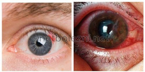 От чего лопаются сосуды в глазах: причины и профилактика