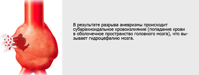 Аневризма головного мозга: что такое, почему возникает, группы риска, классификация, симптомы, осложнения, последствия, диагностика, лечение