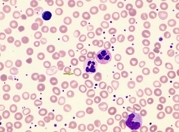 Железодефицитная анемия симптомы