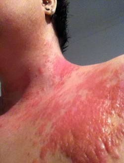 Крапивница у взрослых: симптомы и лечение, фото заболевания