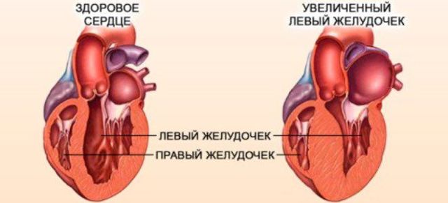 Гипертрофия левого желудочка сердца: признаки на ЭКГ и лечение