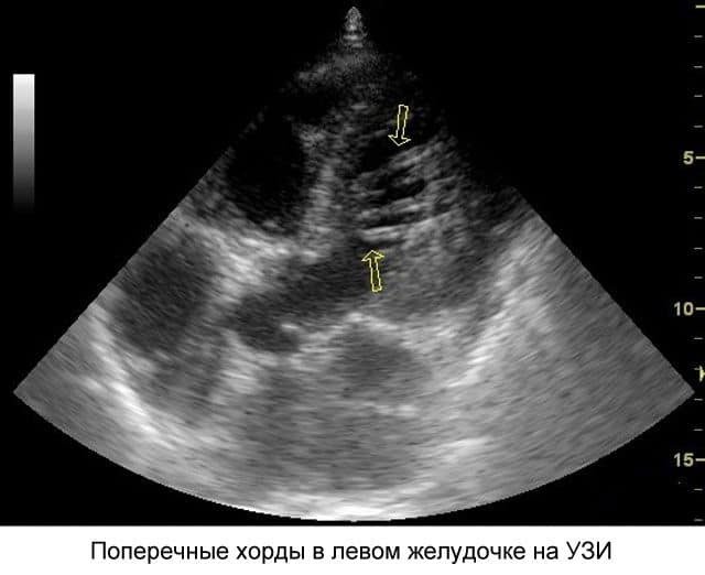 Ложная хорда левого желудочка - причины и лечение