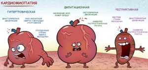 Кардиомиопатия: что это такое, виды, симптомы и лечение