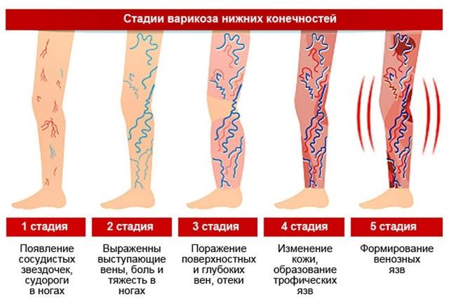 Как лечить варикоз на ногах у женщин народными средствами