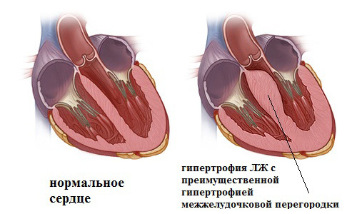 Гипертрофия мжп сердца что это. Гипертрофия мжп что это
