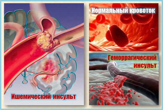 Ишемический инсульт: симптомы и лечение