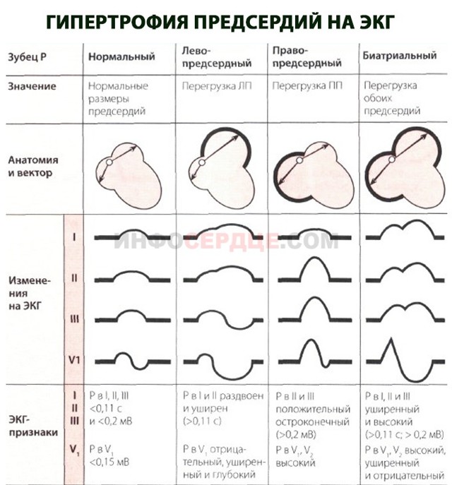 Перегрузка правого предсердия причины - Все про гипертонию