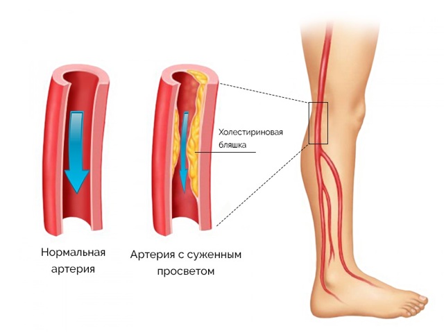 При сахарном диабете - как лечить и чистить сосуды?