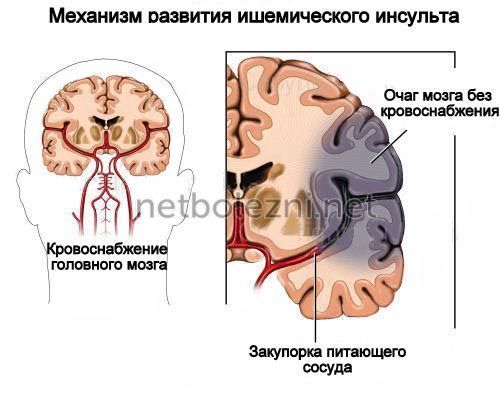Инсульт левая или правая сторона, последствия, сколько живут