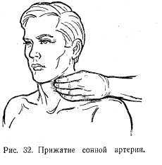 Лигирование сосудов в ране с целью окончательной остановки кровотечения