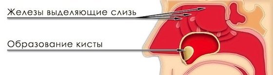 Киста зуба — причины, признаки и симптомы, лечение