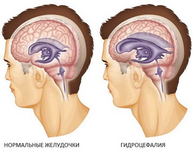 Инсульт левая или правая сторона, последствия, сколько живут