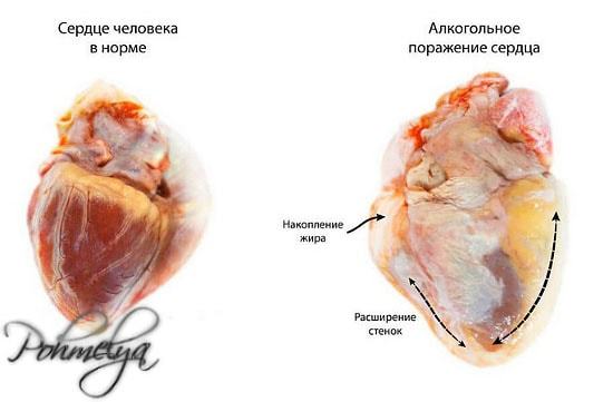 Сердце алкоголика и влияние алкоголя на него
