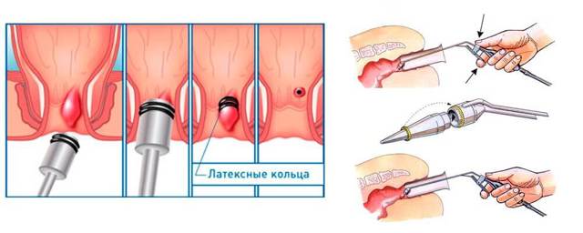 Что такое лигирование внутреннего геморроидального узла — Сайт о геморрое