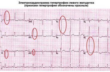 Расшифровка ЭКГ — норма и отклонения, выявление патологий