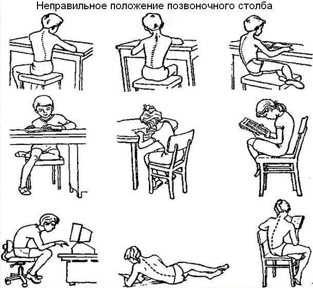 Лордоз – что это такое, как лечить и предупредить