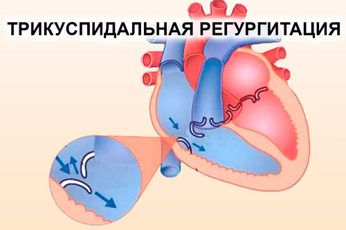 Регургитация трикуспидального клапана 1 степени