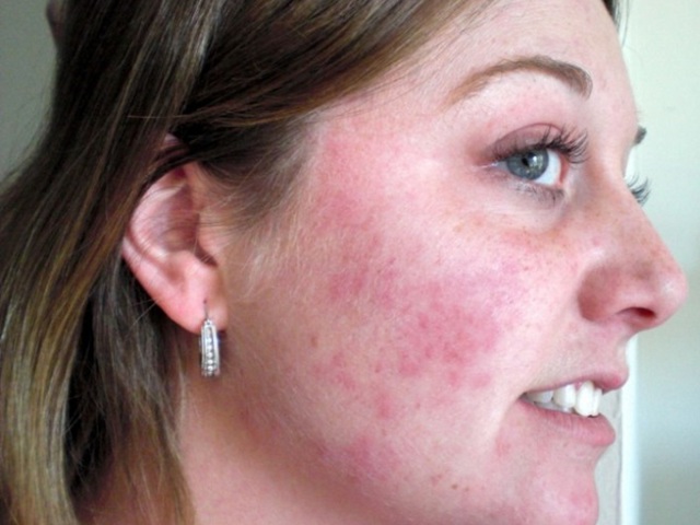 Спрегаль спрей: цена, инструкция по применению и отзывы